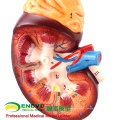 SELL 12434 Enlarge Model Kidney ,2 Part , Anatomy Urinary Models